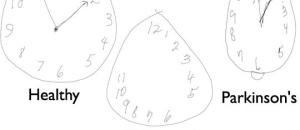  alt="Un stylo connecté et des horloges pour détecter en amont la maladie d'Alzheimer"