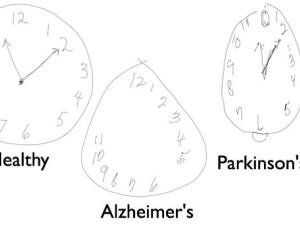  alt="Un stylo connecté et des horloges pour détecter en amont la maladie d'Alzheimer"
